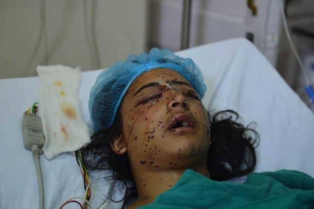 Kashmir Pallet gun use on protestors